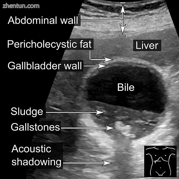 Biliary sludge and gallstones. There is borderline thickening of the gallbladder wall..jpg