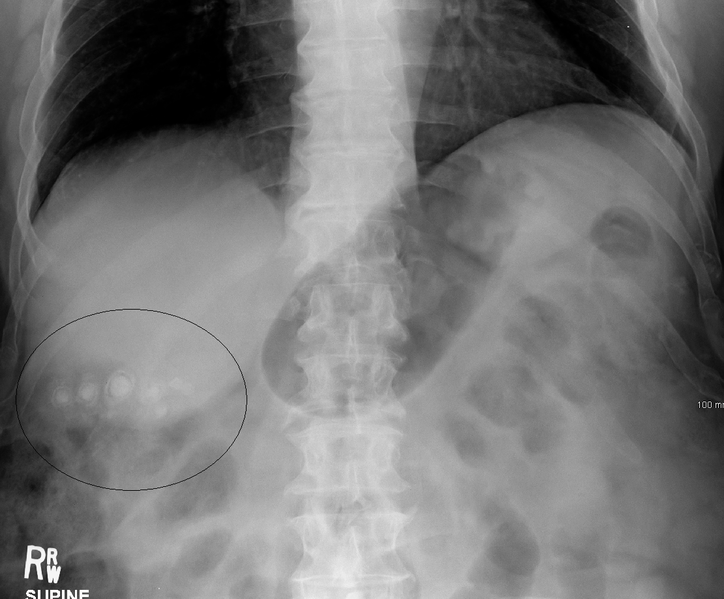 Gallstones as seen on plain X-ray.png