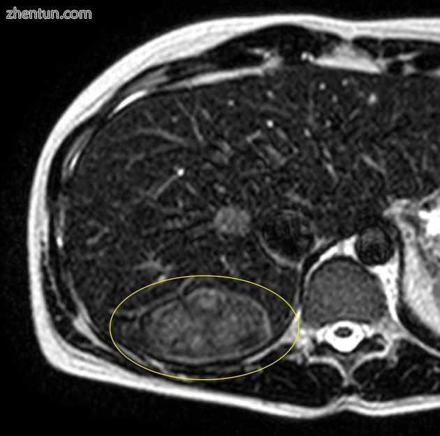 肝腺瘤-环礁征