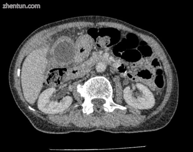 亚急性胆囊穿孔- II型