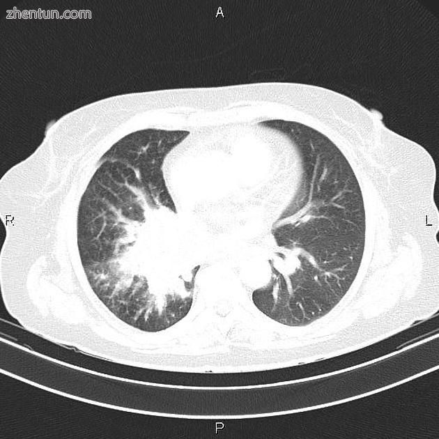 转移性肺癌