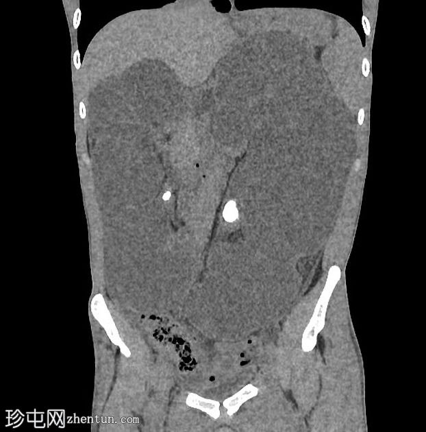 双侧肾盂结石