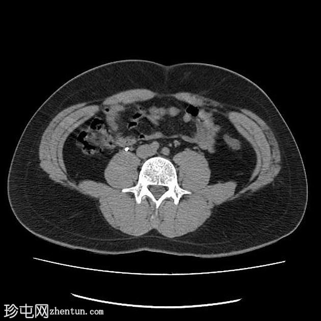 双侧PUJ梗阻患者植入输尿管支架