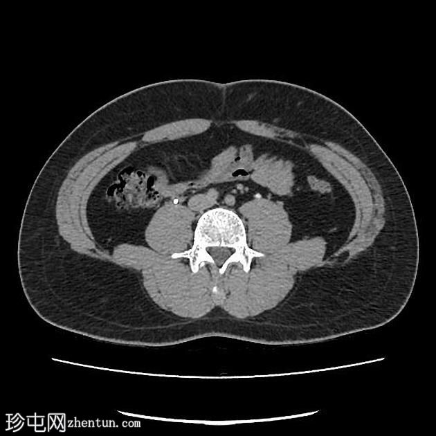 双侧PUJ梗阻患者植入输尿管支架