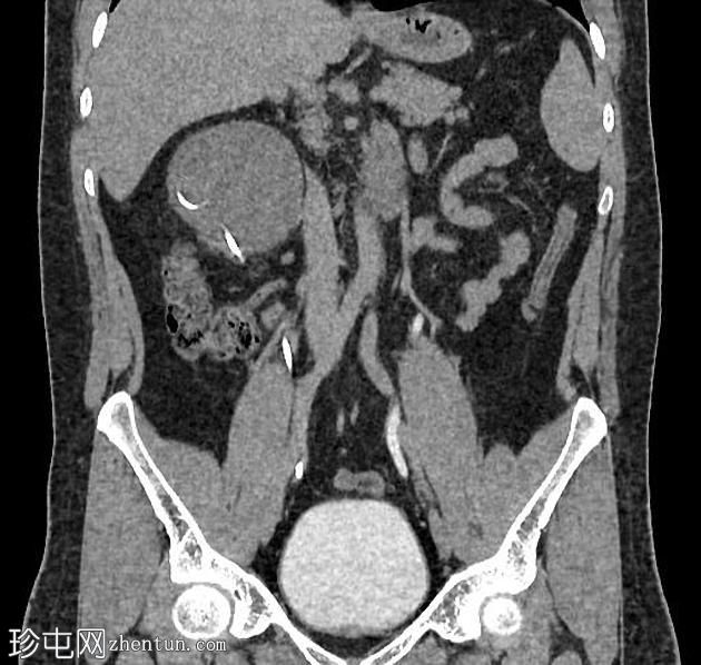 双侧PUJ梗阻患者植入输尿管支架