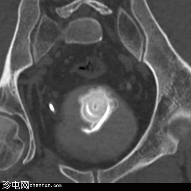 双侧PUJ梗阻患者植入输尿管支架