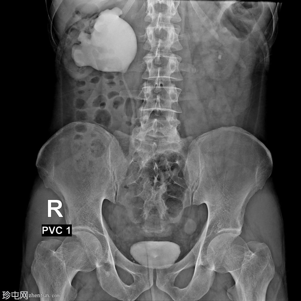 肾盂输尿管交界处梗阻