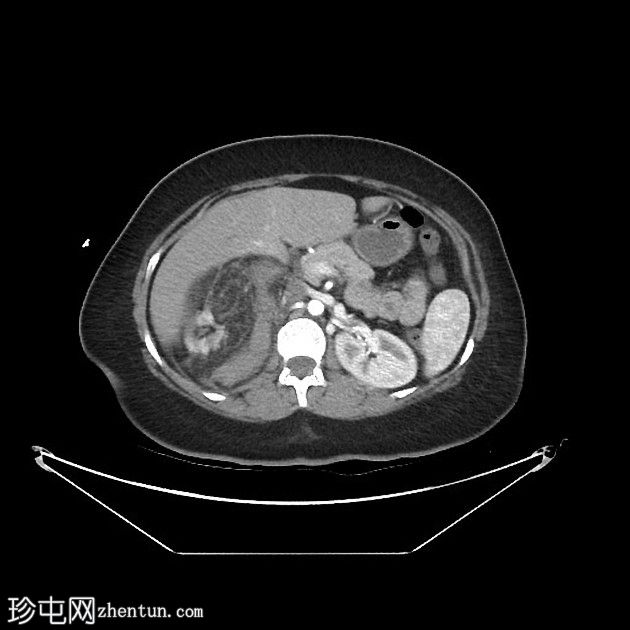 肾血管平滑肌脂肪瘤出血 - Wunderlich 综合征