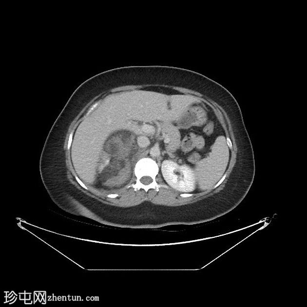 肾血管平滑肌脂肪瘤出血 - Wunderlich 综合征