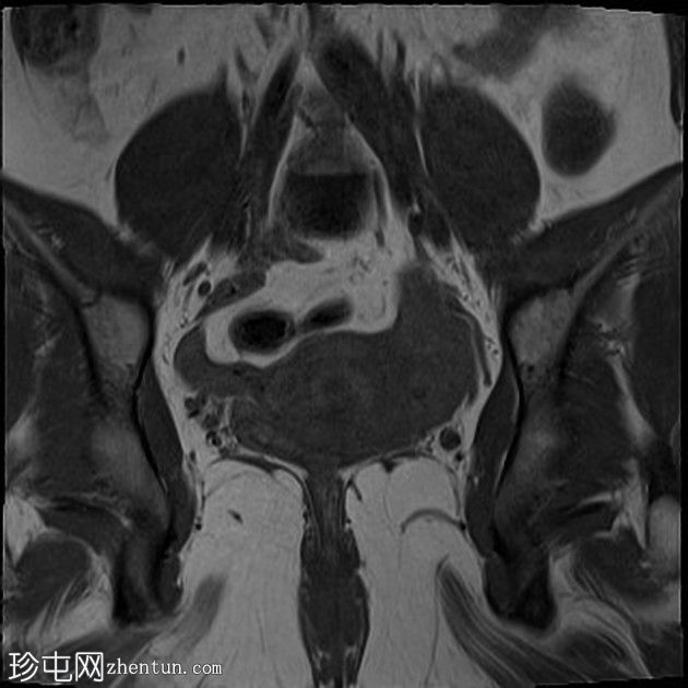 子宫前倾与脱垂的粘膜下平滑肌瘤