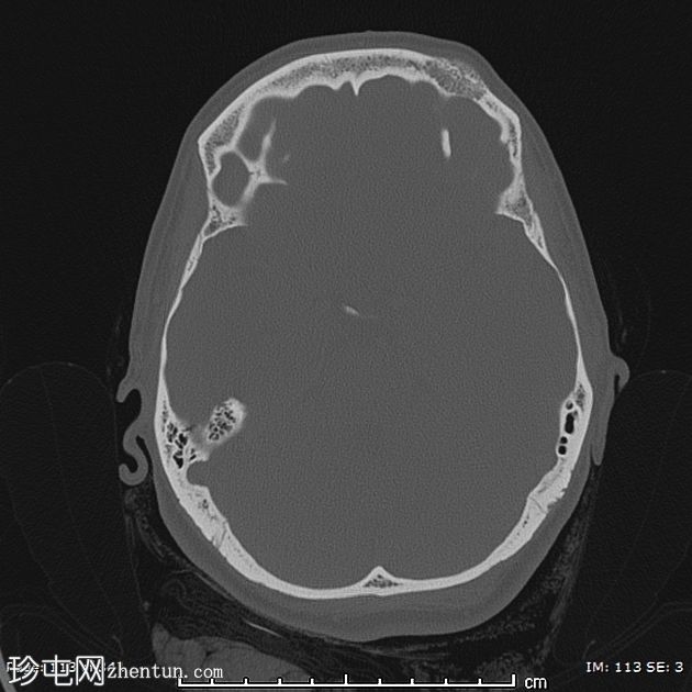骨内血管瘤-额骨