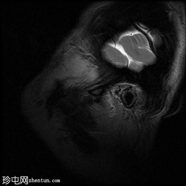 无法复位的前颞下颌关节盘脱位-双侧