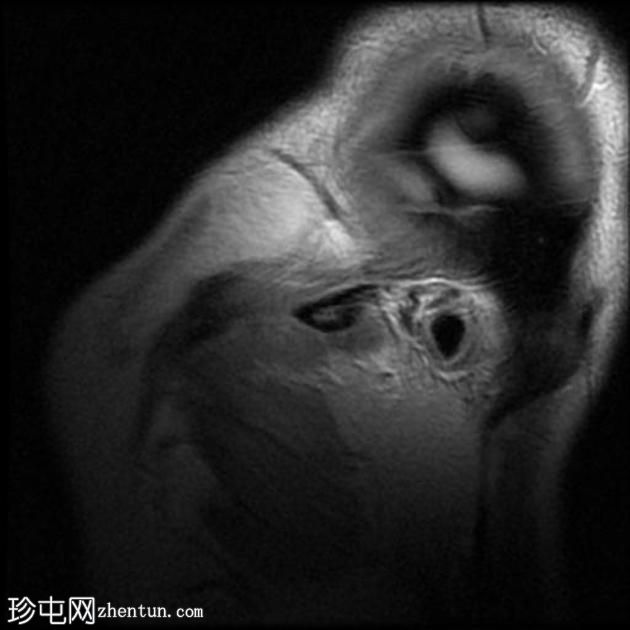 无法复位的前颞下颌关节盘脱位-双侧