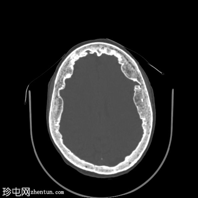 额壁骨质增生