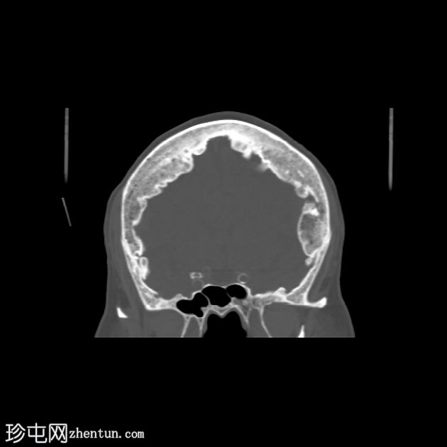 额壁骨质增生