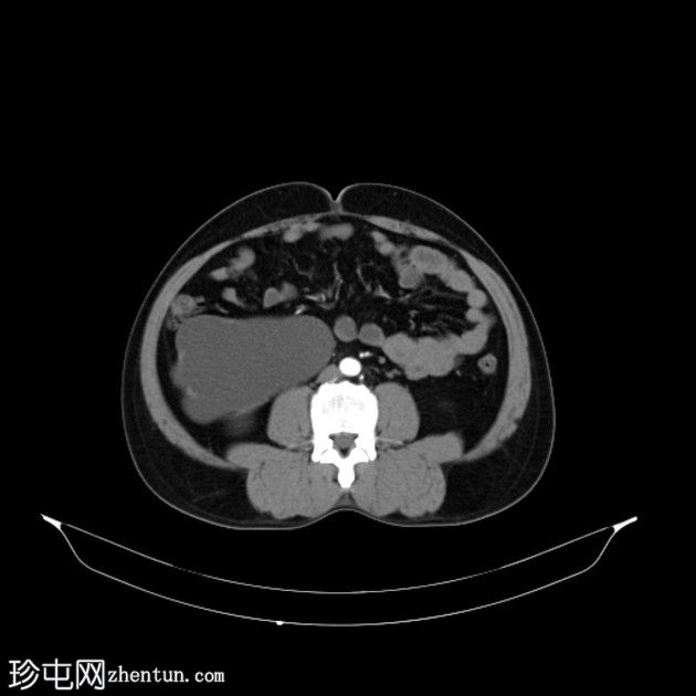 重度肾积水