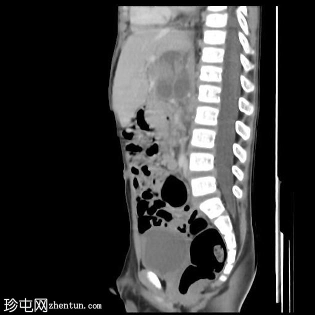 成神经细胞瘤