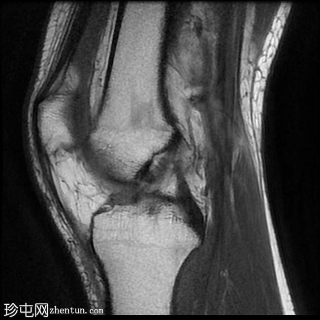 内侧副韧带断裂