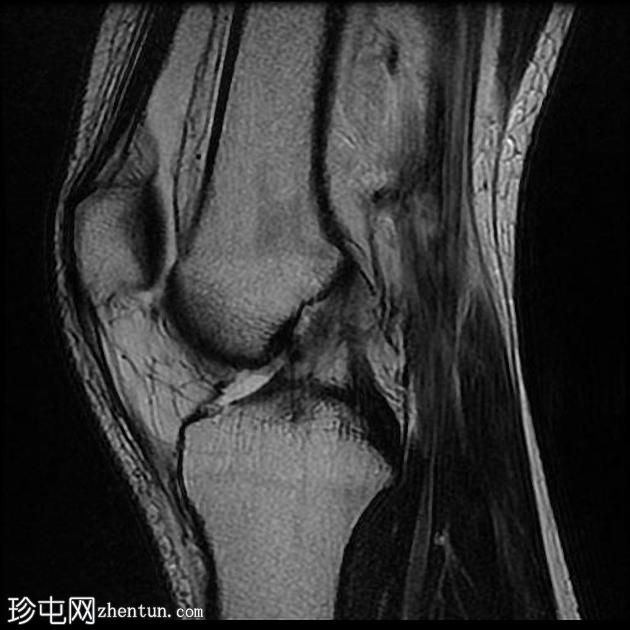 内侧副韧带断裂