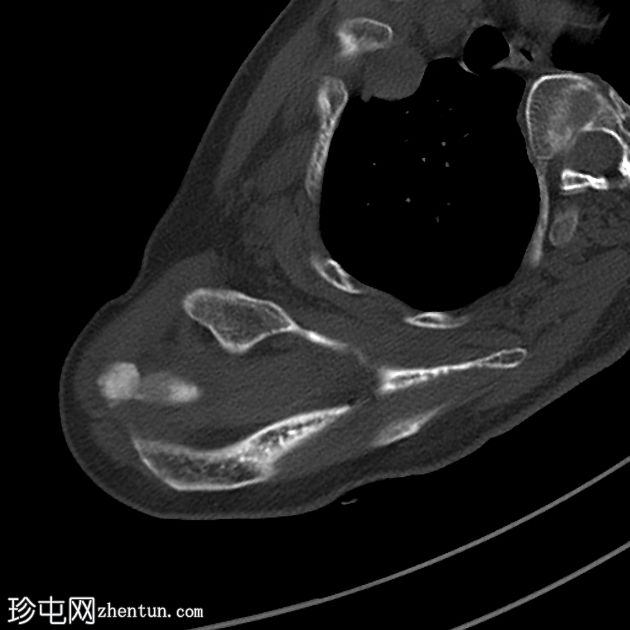 冈上肌腱钙化性肌腱炎