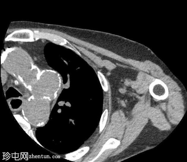偶发的胸主动脉假性动脉瘤和肺鳞状细胞癌