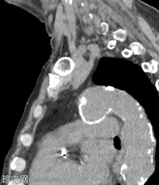 偶发的胸主动脉假性动脉瘤和肺鳞状细胞癌