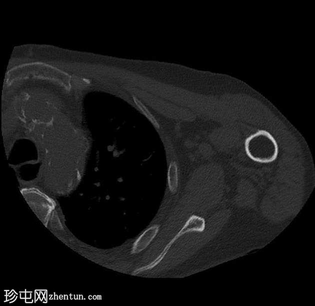 偶发的胸主动脉假性动脉瘤和肺鳞状细胞癌