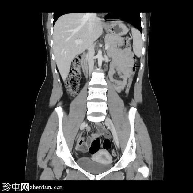 肝包虫囊肿- CE4期