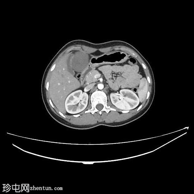 肝包虫囊肿- CE4期