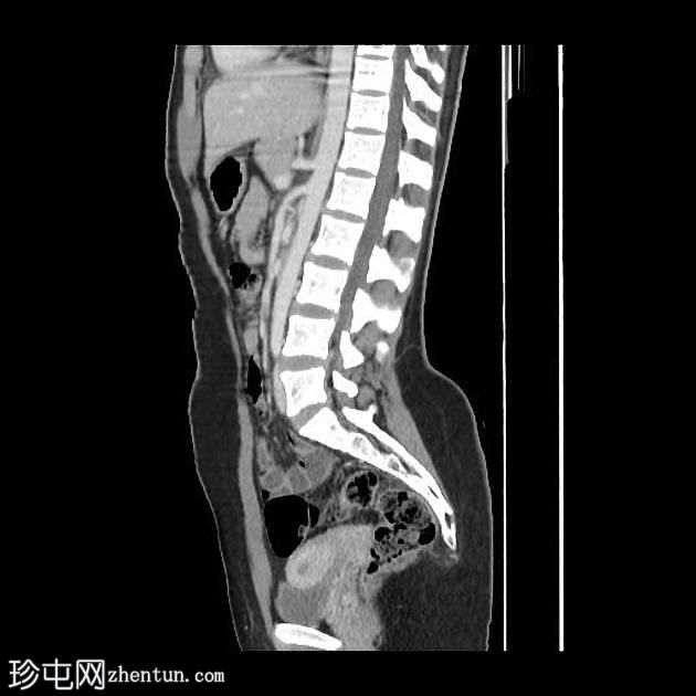 肝包虫囊肿- CE4期