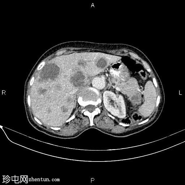 转移性胰腺癌