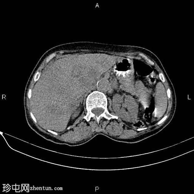 转移性胰腺癌