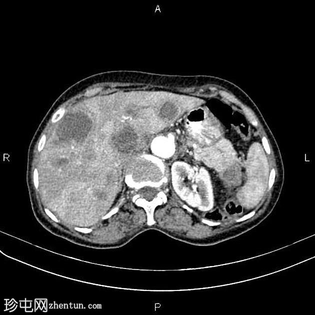 转移性胰腺癌