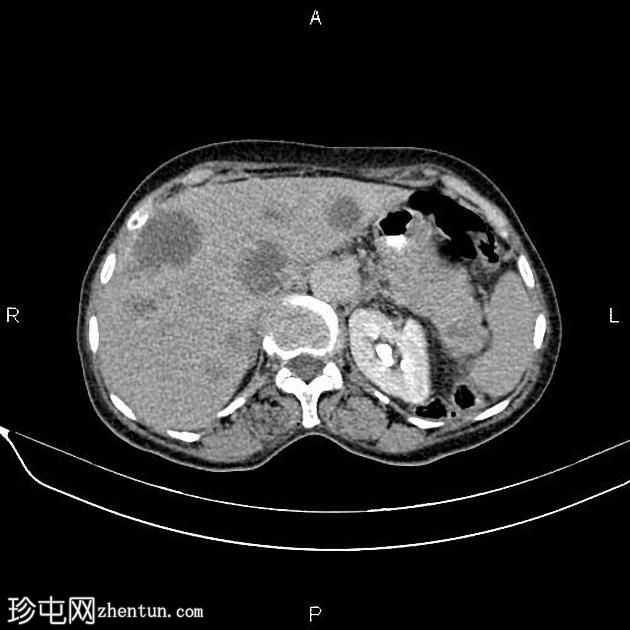 转移性胰腺癌