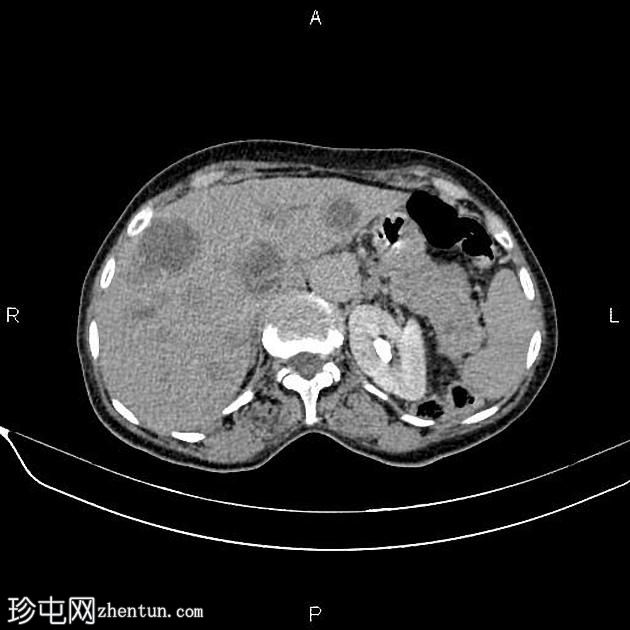 转移性胰腺癌