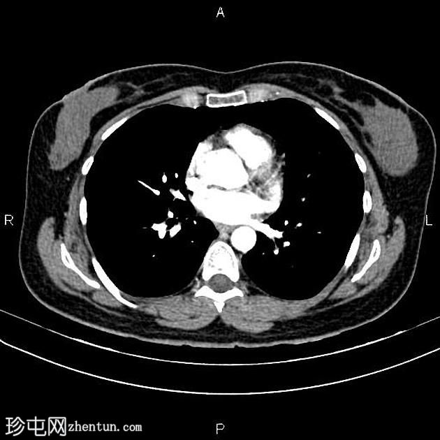 转移性乳腺癌