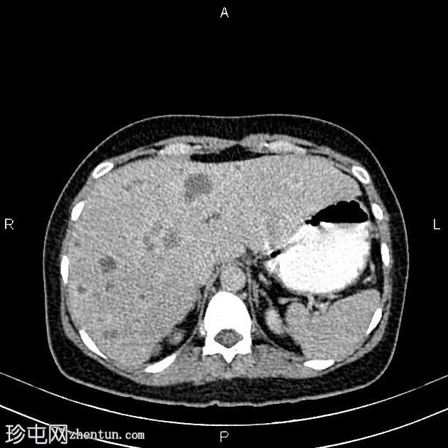 转移性乳腺癌