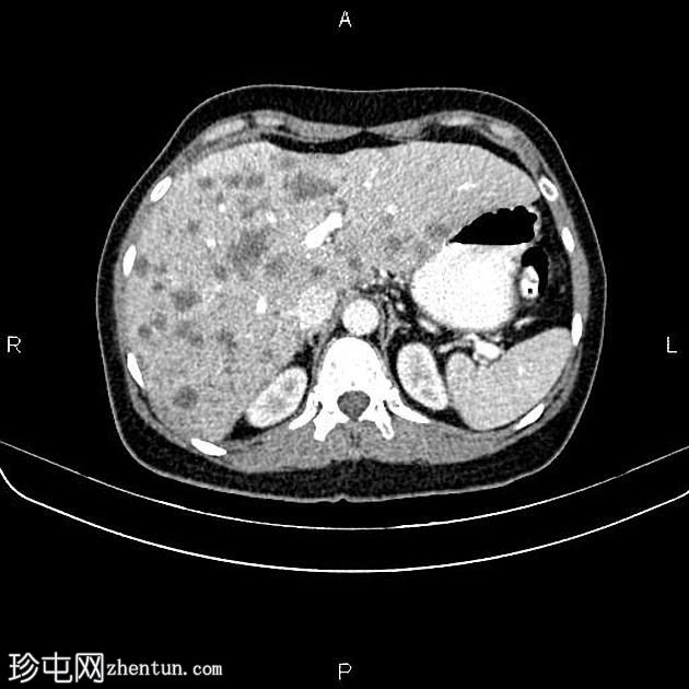 转移性乳腺癌