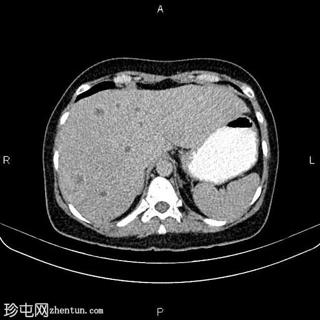 转移性乳腺癌