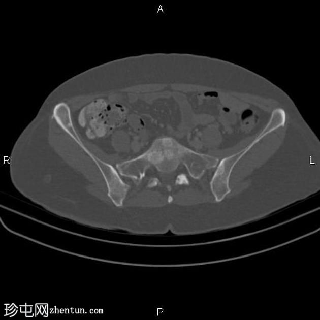 转移性乳腺癌