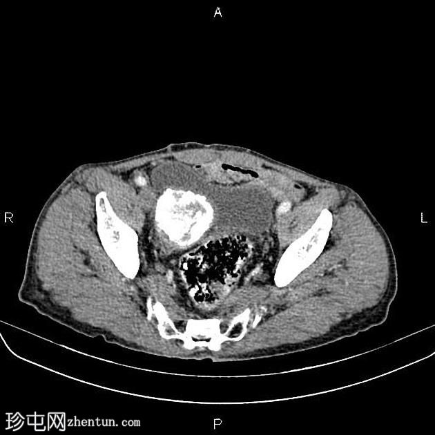 肝和盆腔棘球蚴囊肿