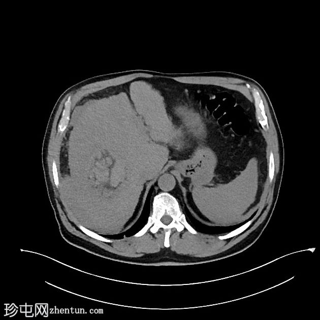 肝癌合并腹腔积血因肿瘤直接侵犯右膈