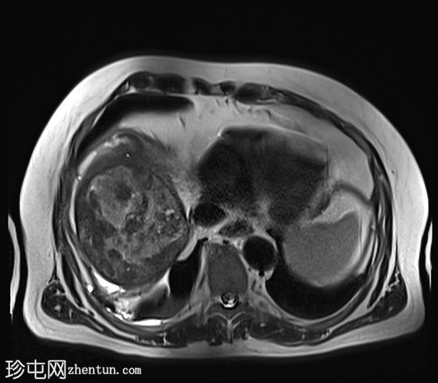 肝癌合并腹腔积血因肿瘤直接侵犯右膈