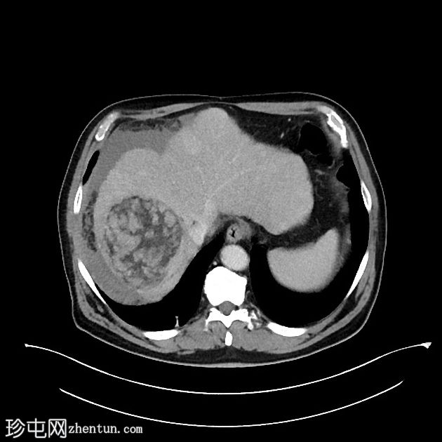 肝癌合并腹腔积血因肿瘤直接侵犯右膈