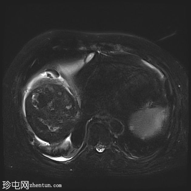 肝癌合并腹腔积血因肿瘤直接侵犯右膈