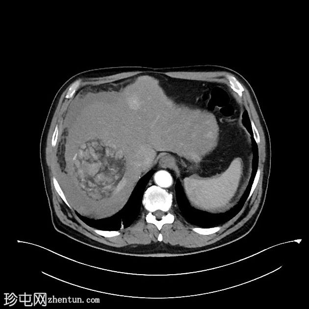 肝癌合并腹腔积血因肿瘤直接侵犯右膈