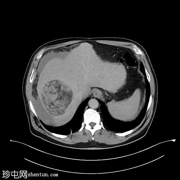 肝癌合并腹腔积血因肿瘤直接侵犯右膈