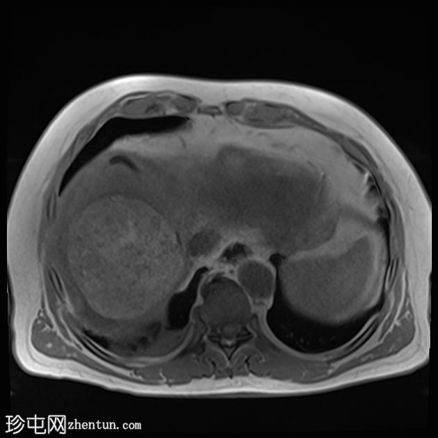 肝癌合并腹腔积血因肿瘤直接侵犯右膈