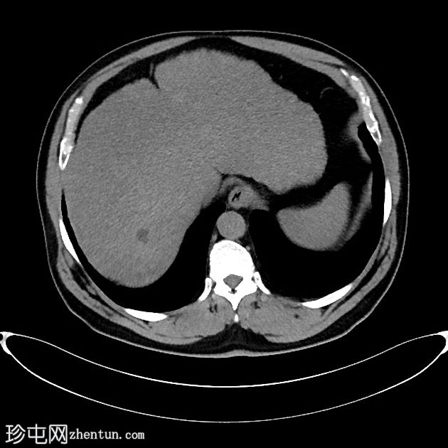 肝癌合并腹腔积血因肿瘤直接侵犯右膈