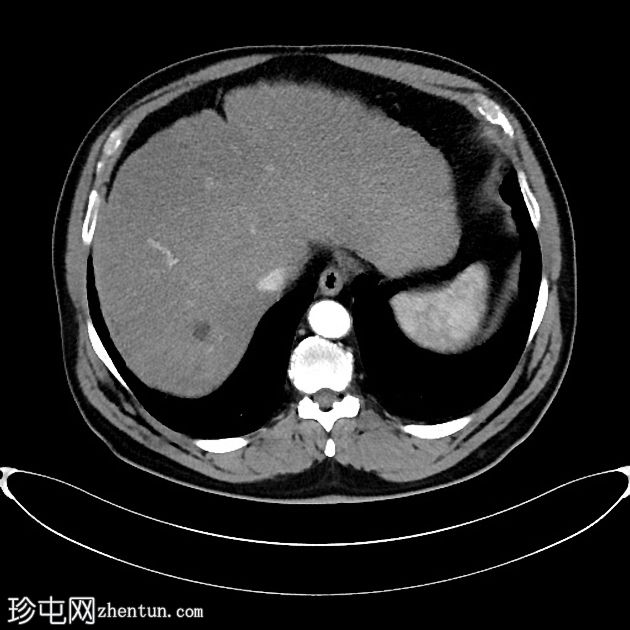 肝癌合并腹腔积血因肿瘤直接侵犯右膈